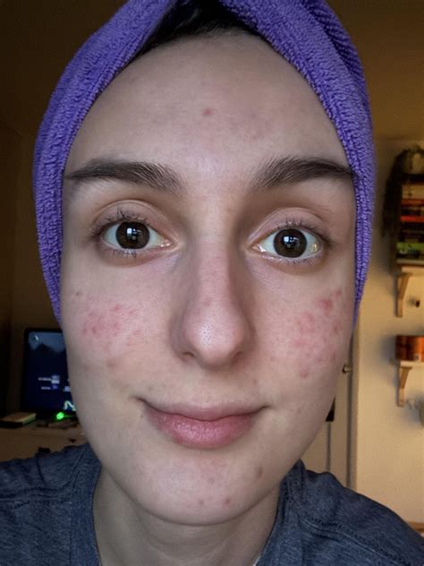 Image result for How to Fix Cheeck Spots