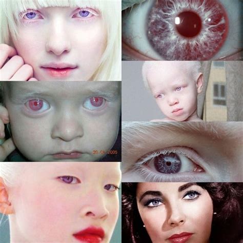 Light Blue Eyes Albinism に対する画像結果