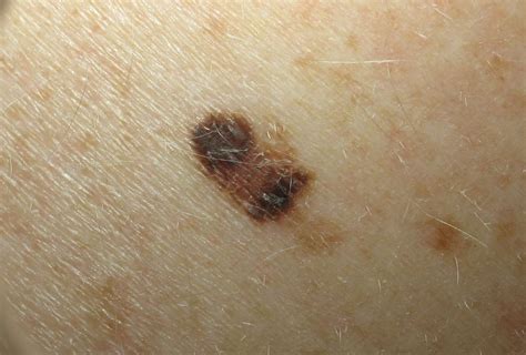 Bildergebnis für Skin Cancer vs Mole