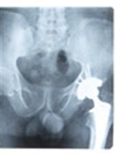 Image result for Hip Fracture with MRSA Cellulitis