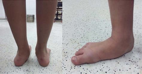 Image result for Pes Planovalgus