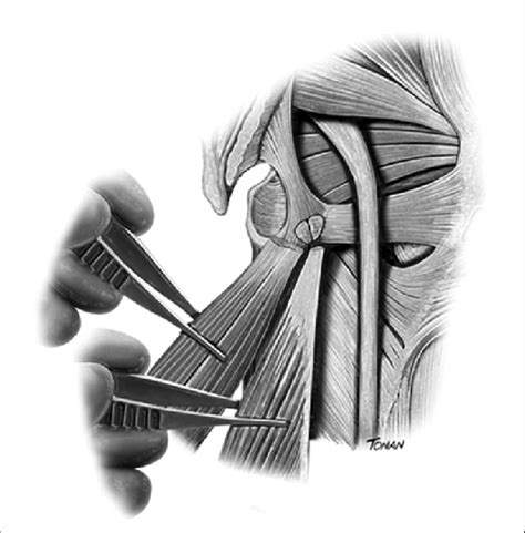 Image result for Conjoined Tendon Hamstring