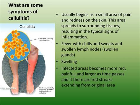 Résultat d’images pour ATI System Disorder Template Cellulitis