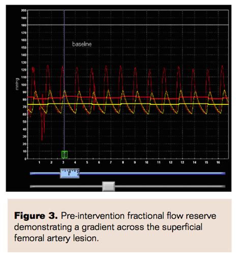 Pressure Gradient Segmental Pressure Lower Extremity に対する画像結果