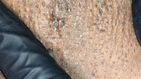 Image result for Painful Pimple Under Armpit