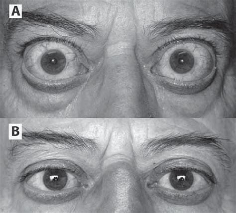 Image result for Exopthalmia