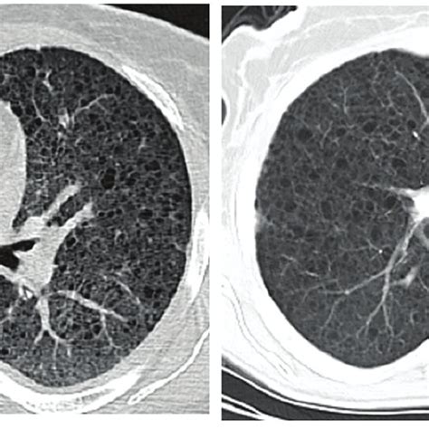 Image result for High Resolution CT Scan