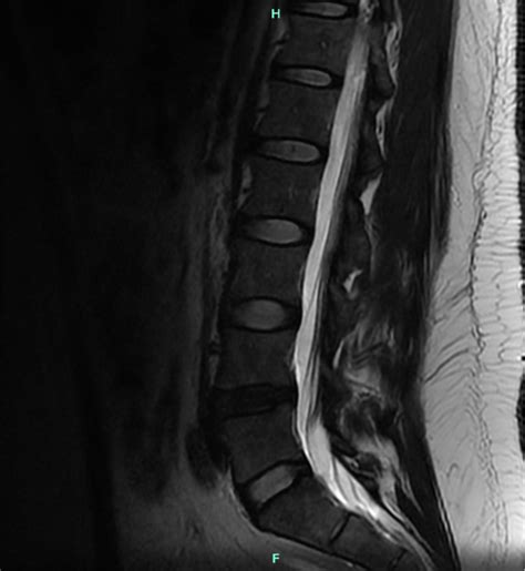 Image result for Facet Compression Test