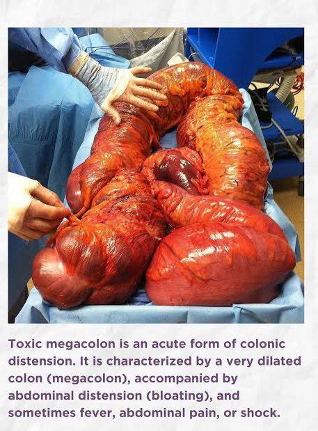 Toxic Megacolon Next to Normal に対する画像結果