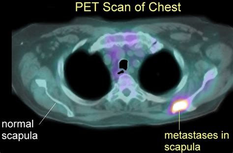 Image result for Bone Marrow Cancer On Pet Scan