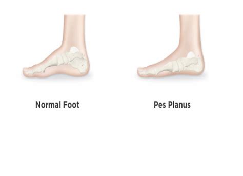 Image result for Pes Planovalgus