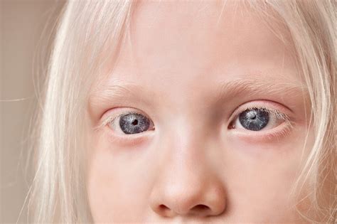 Light Blue Eyes Albinism に対する画像結果