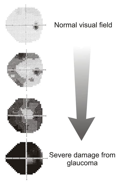 Image result for Field Vision Test