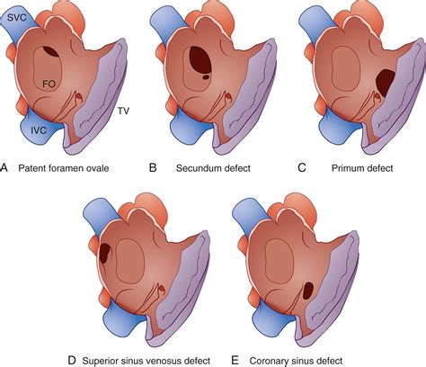 Toradh íomhá ar Atrial Septal Defect Classification