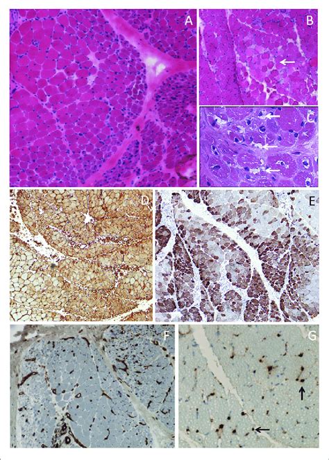 Toradh íomhá ar Perifasicular Atrophy in Dermatomyositis