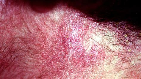 Toradh íomhá ar Dermatomyositis in Children