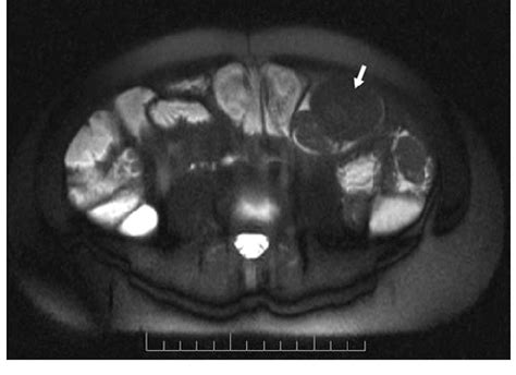 Image result for MRI Enteroclysis