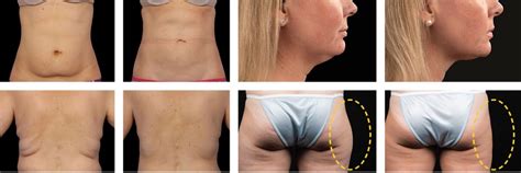 Image result for CoolSculpting On Cheeks