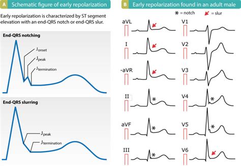 Toradh íomhá ar ECG Re-Entry