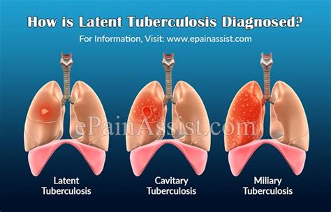 Image result for Tuberculosis Latent Stage