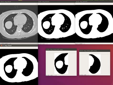 Lung Cancer Detection Using Image Processing GitHub కోసం చిత్ర ఫలితం