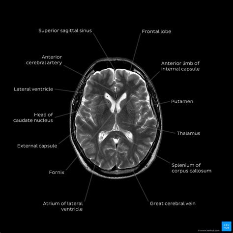 Image result for Normal Brain MRI