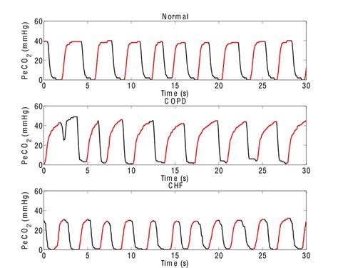 Toradh íomhá ar Normal Capnography Waveform