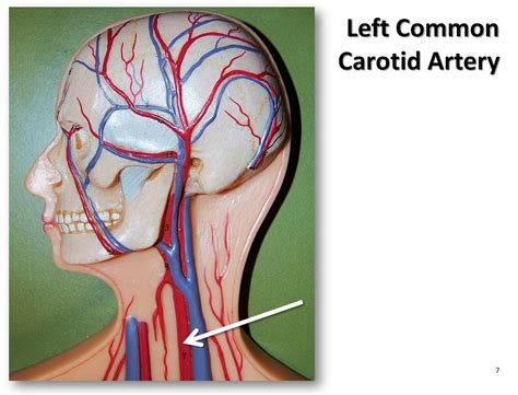 Toradh íomhá ar Common Carteroid Artery