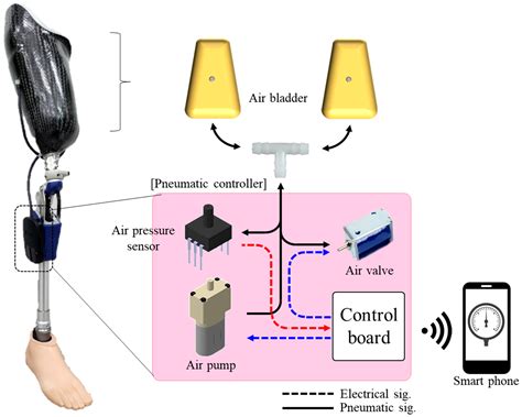 Image result for Direct Socket Prosthesis
