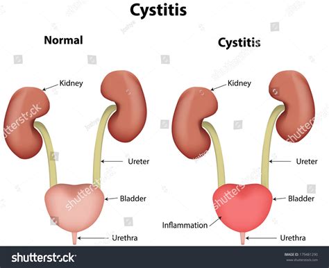 Image result for Cystitis Diagram