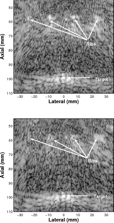 Image result for Flat Rectangular Array HIFU