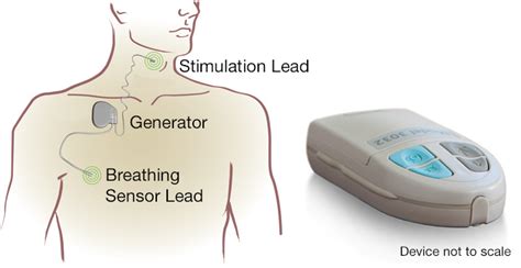 Afbeeldingsresultaten voor Sleep Apnea Pacemaker Device