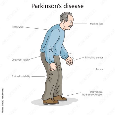 Image result for Sequence Diagram for Parkinson Disease