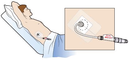 Afbeeldingsresultaten voor How to Flush a Gallbladder Tube