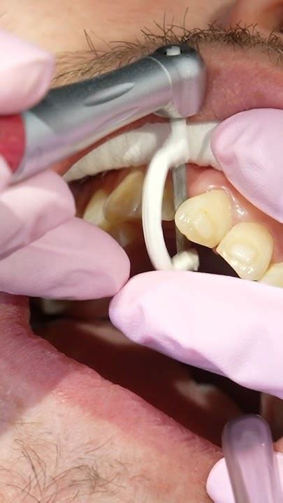 IPR Testing માટે ઇમેજ પરિણામ