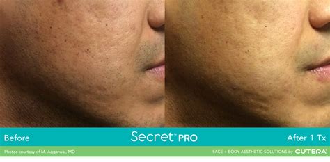Toradh íomhá ar RF Micro Needling Harrisburg PA