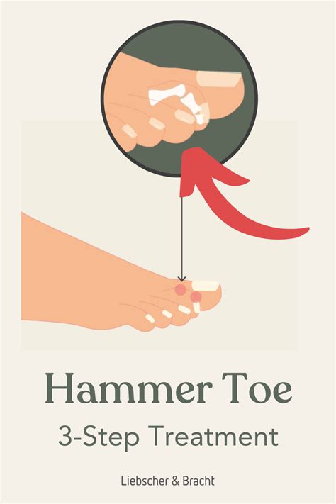 Image result for Hammer Toe Problems