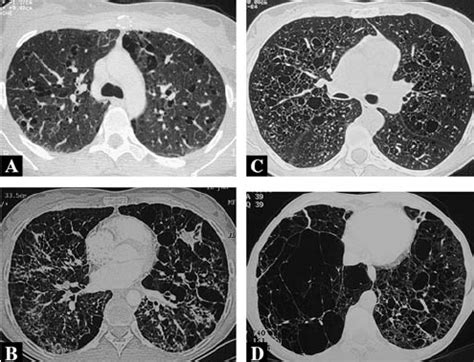 Image result for High Resolution CT Scan