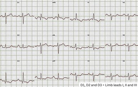 Afbeeldingsresultaten voor ECG Study