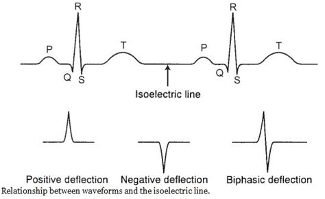 Image result for Positive Deflection ECG