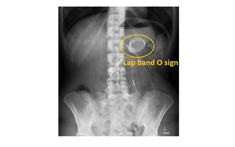 Image result for Lap Band Device X-ray