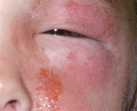 Rhus Dermatitis Face-এর ছবি ফলাফল