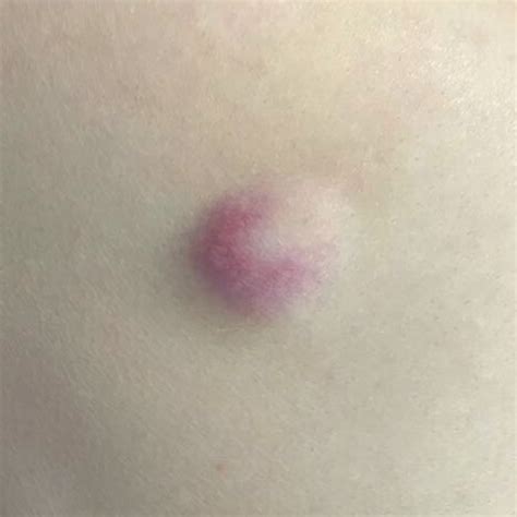 Lancing a Sebaceous Cyst に対する画像結果