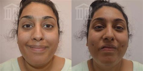 Toradh íomhá ar Artificial Dimples