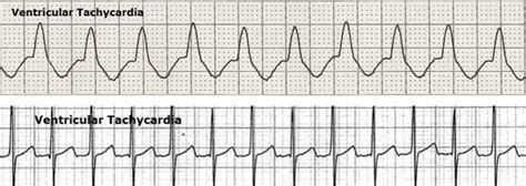 Afbeeldingsresultaten voor Pulseless Ayssotle Algorithm