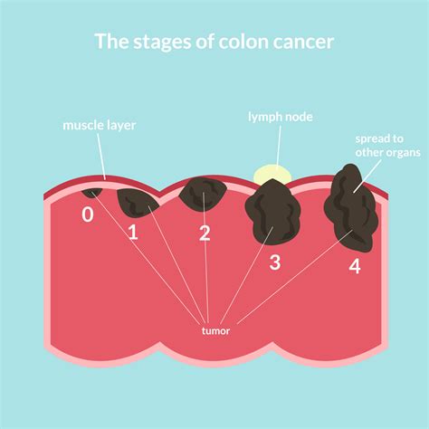 Image result for Stage 1 Colon Cancer