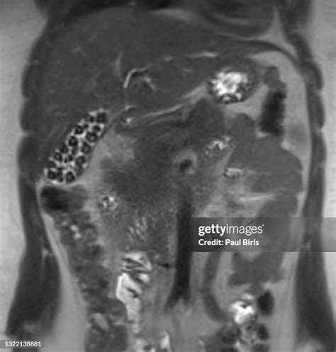 Image result for MRI Gallbladder