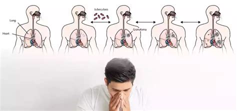 Image result for Tuberculosis Latent Stage