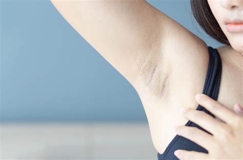 Image result for Painful Pimple Under Armpit