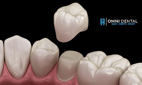 Toradh íomhá ar Getting a Crown Tooth